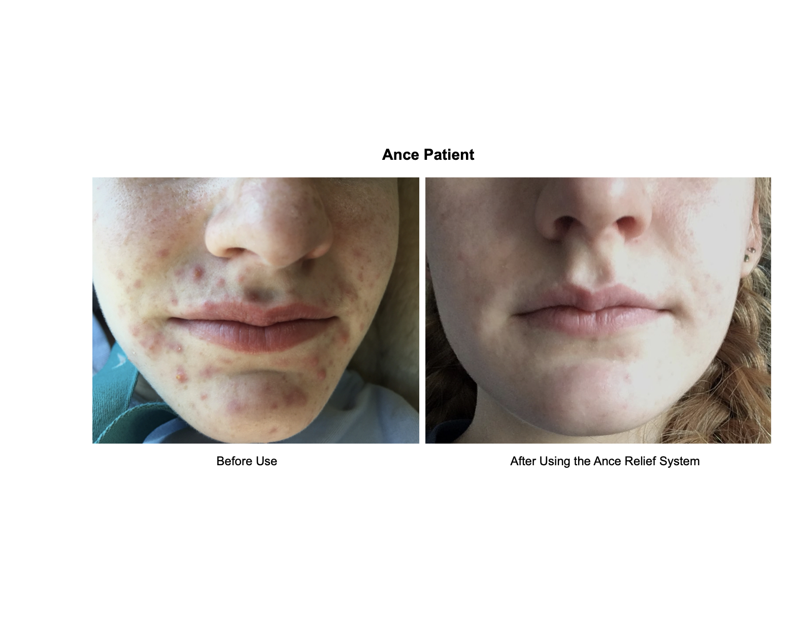 Advanced skincare technology in use